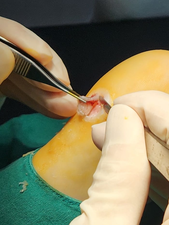 Plantar Corns, Calluses, and Warts: Why You Should See a Foot Specialist — 5