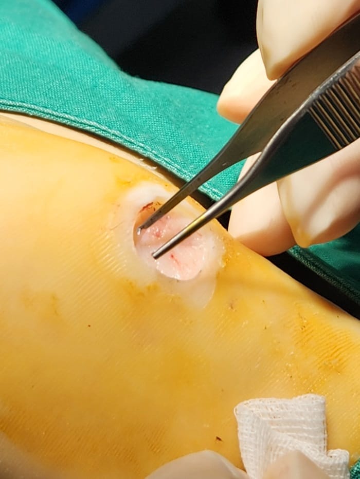 Plantar Corns, Calluses, and Warts: Why You Should See a Foot Specialist — 6