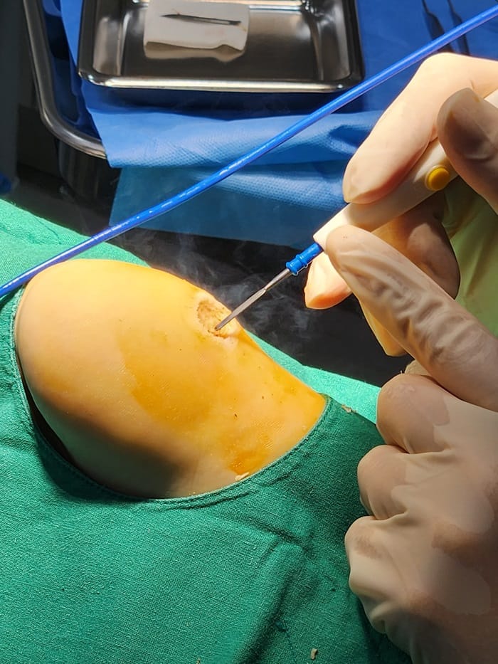 Plantar Corns, Calluses, and Warts: Why You Should See a Foot Specialist — 7