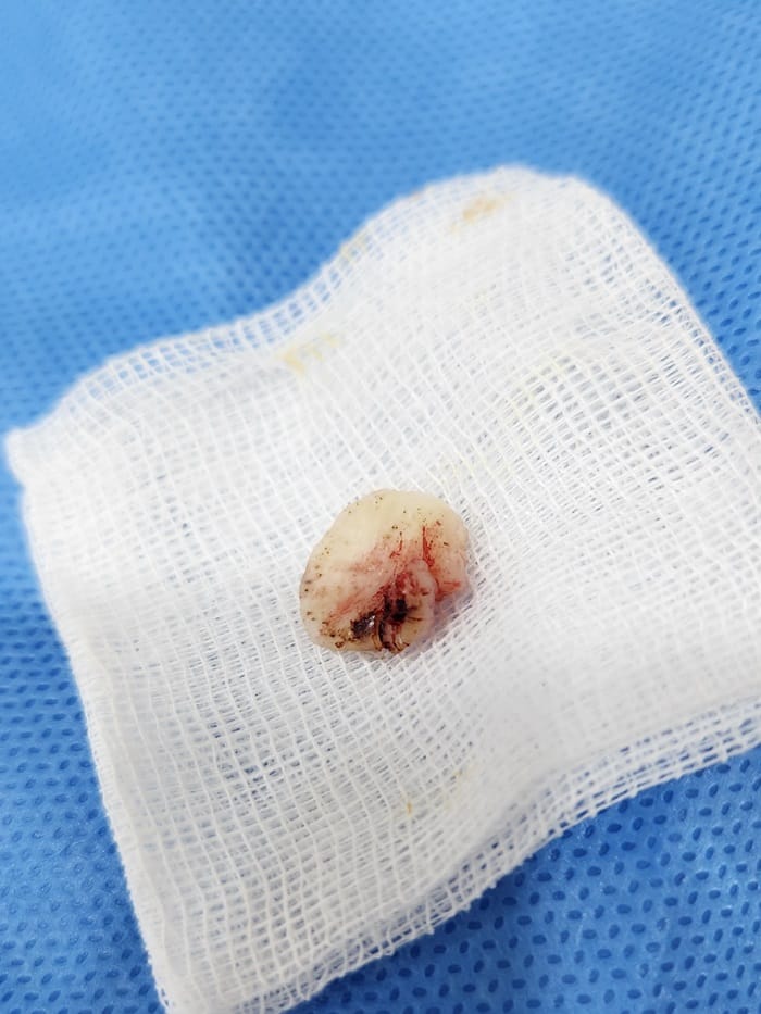 Plantar Corns, Calluses, and Warts: Why You Should See a Foot Specialist — 8