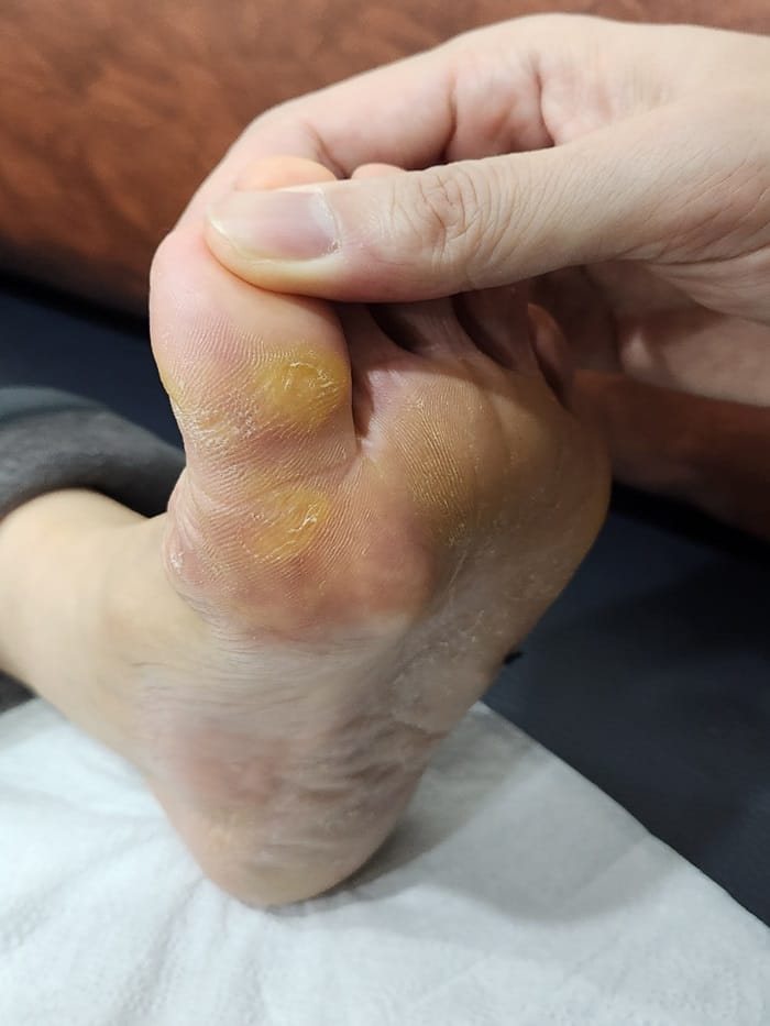 Foot Pain from Plantar Calluses: When to See a Specialist — 4