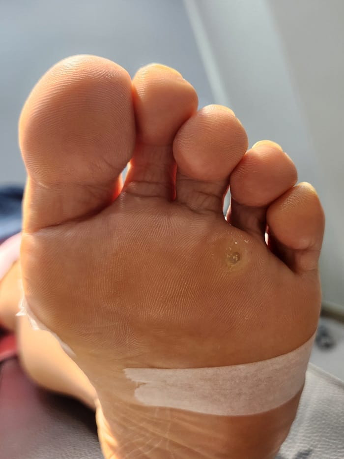 Plantar Corns, Calluses & Warts: Why an Accurate Diagnosis Is Essential for Foot and Back Pain
