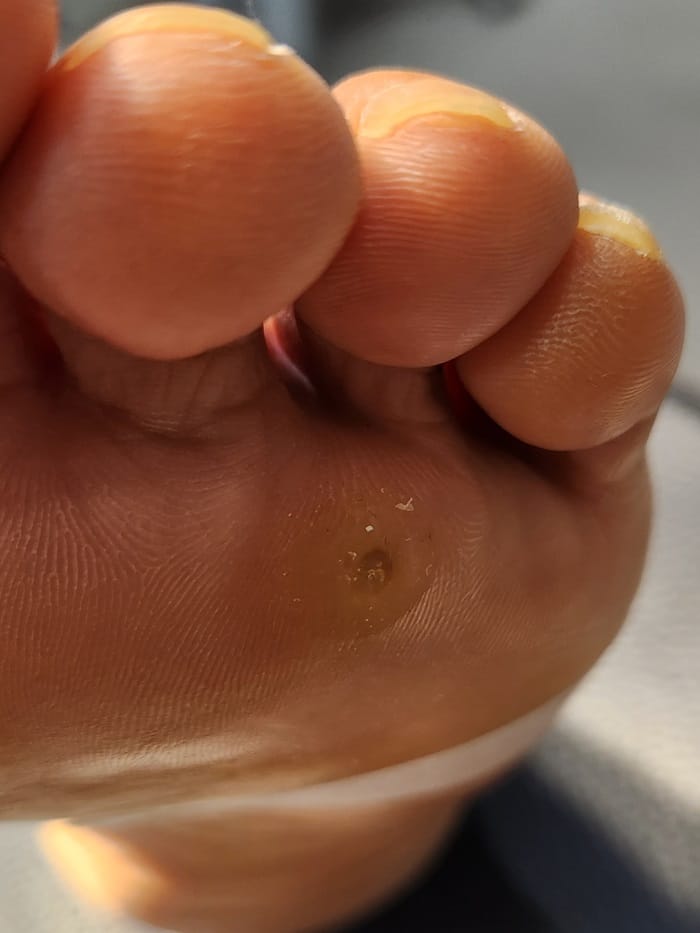 Plantar Corns, Calluses & Warts: Why an Accurate Diagnosis Is Essential for Foot and Back Pain — 2