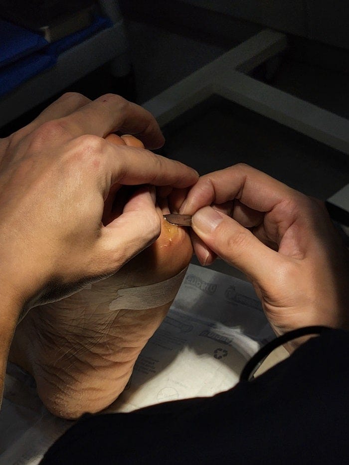 Plantar Corns, Calluses & Warts: Why an Accurate Diagnosis Is Essential for Foot and Back Pain — 3