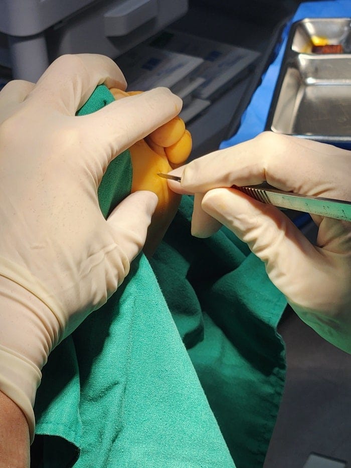 Plantar Corns, Calluses & Warts: Why an Accurate Diagnosis Is Essential for Foot and Back Pain — 4