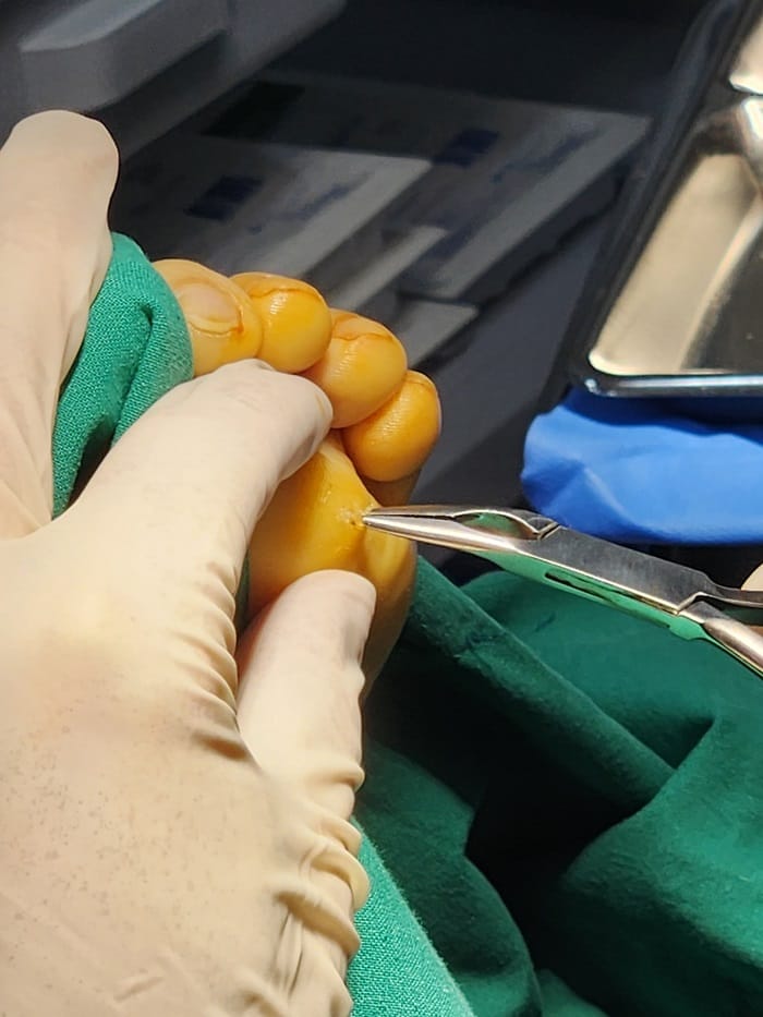 Plantar Corns, Calluses & Warts: Why an Accurate Diagnosis Is Essential for Foot and Back Pain — 5