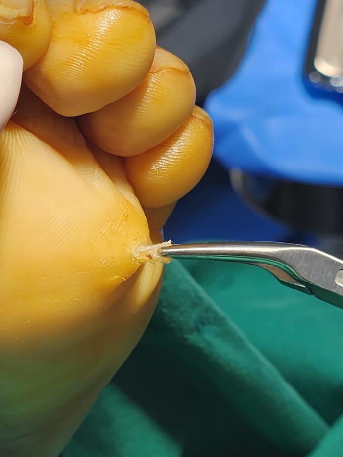 Plantar Corns, Calluses & Warts: Why an Accurate Diagnosis Is Essential for Foot and Back Pain — 6