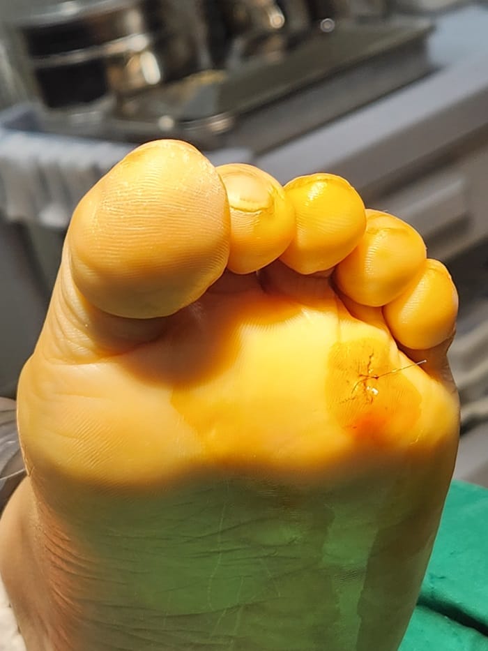 Plantar Corns, Calluses & Warts: Why an Accurate Diagnosis Is Essential for Foot and Back Pain — 8