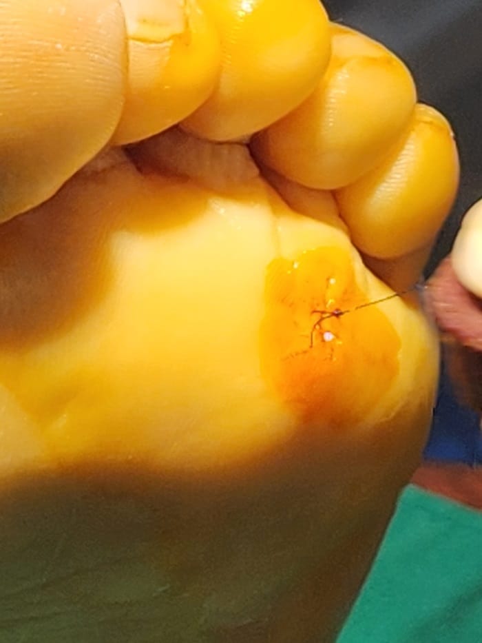 Plantar Corns, Calluses & Warts: Why an Accurate Diagnosis Is Essential for Foot and Back Pain — 9