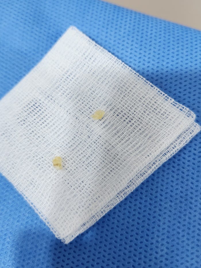 Plantar Corns, Calluses & Warts: Why an Accurate Diagnosis Is Essential for Foot and Back Pain — 10