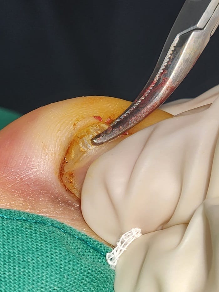 Ingrown Toenail Self-Treatment: Why It Can Worsen Pain, Inflammation, and Infection