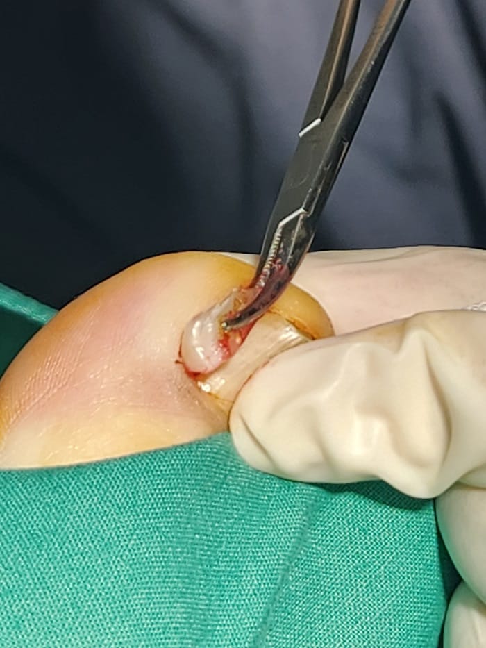 Ingrown Toenail Self-Treatment: Why It Can Worsen Pain, Inflammation, and Infection — 2