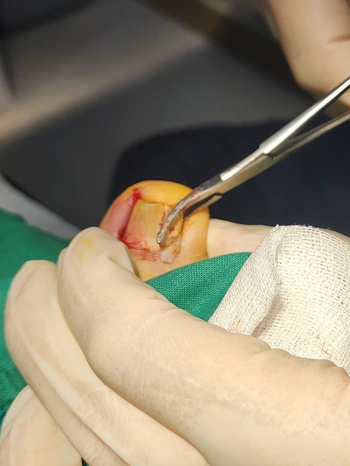 Ingrown Toenail Self-Treatment: Why It Can Worsen Pain, Inflammation, and Infection — 3