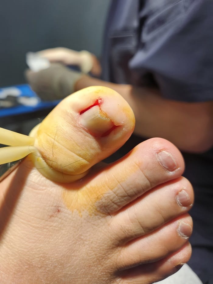 Ingrown Toenail Self-Treatment: Why It Can Worsen Pain, Inflammation, and Infection — 4