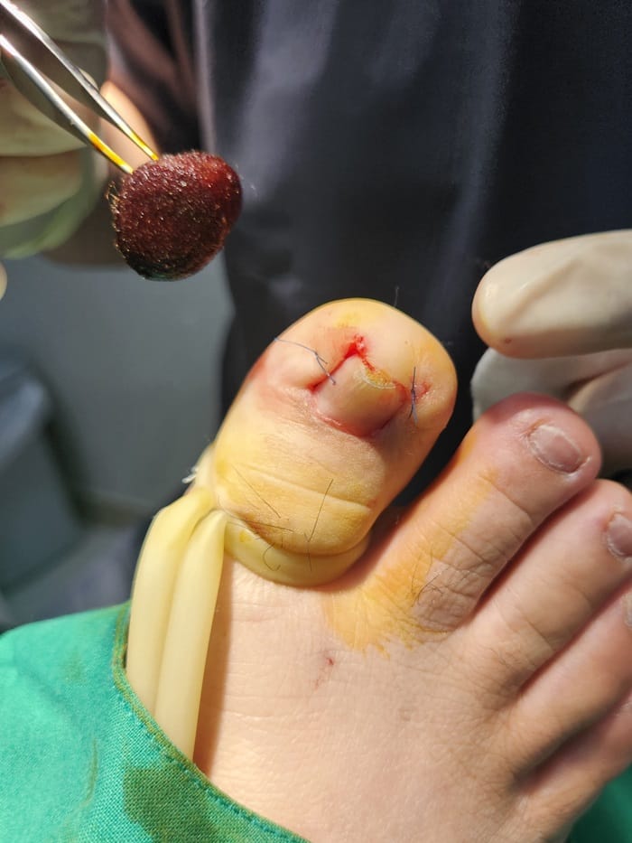 Ingrown Toenail Self-Treatment: Why It Can Worsen Pain, Inflammation, and Infection — 5