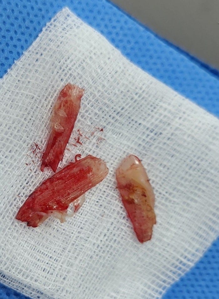 Ingrown Toenail Self-Treatment: Why It Can Worsen Pain, Inflammation, and Infection — 6
