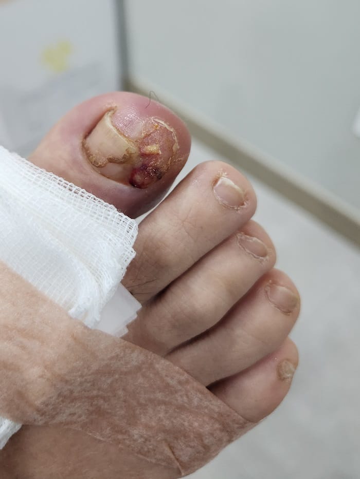 Ingrown Toenail: Causes of Big Toe Pain and Nail Pus Explained