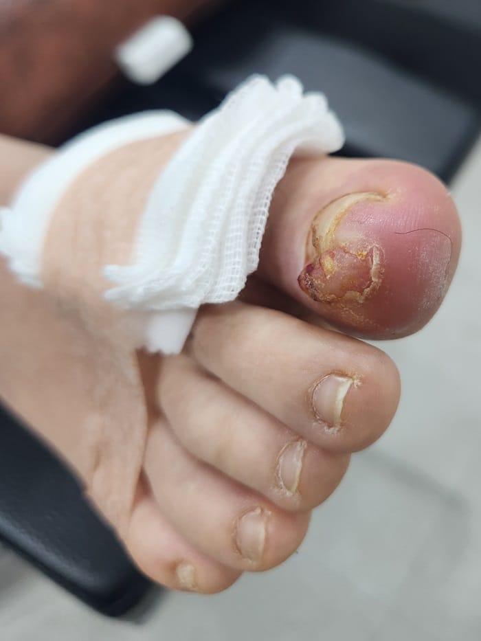 Ingrown Toenail: Causes of Big Toe Pain and Nail Pus Explained — 2