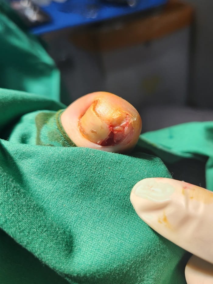 Ingrown Toenail: Causes of Big Toe Pain and Nail Pus Explained — 3
