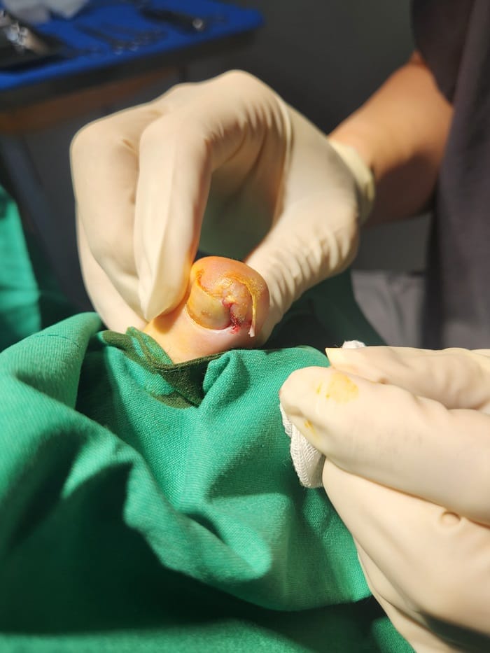 Ingrown Toenail: Causes of Big Toe Pain and Nail Pus Explained — 4