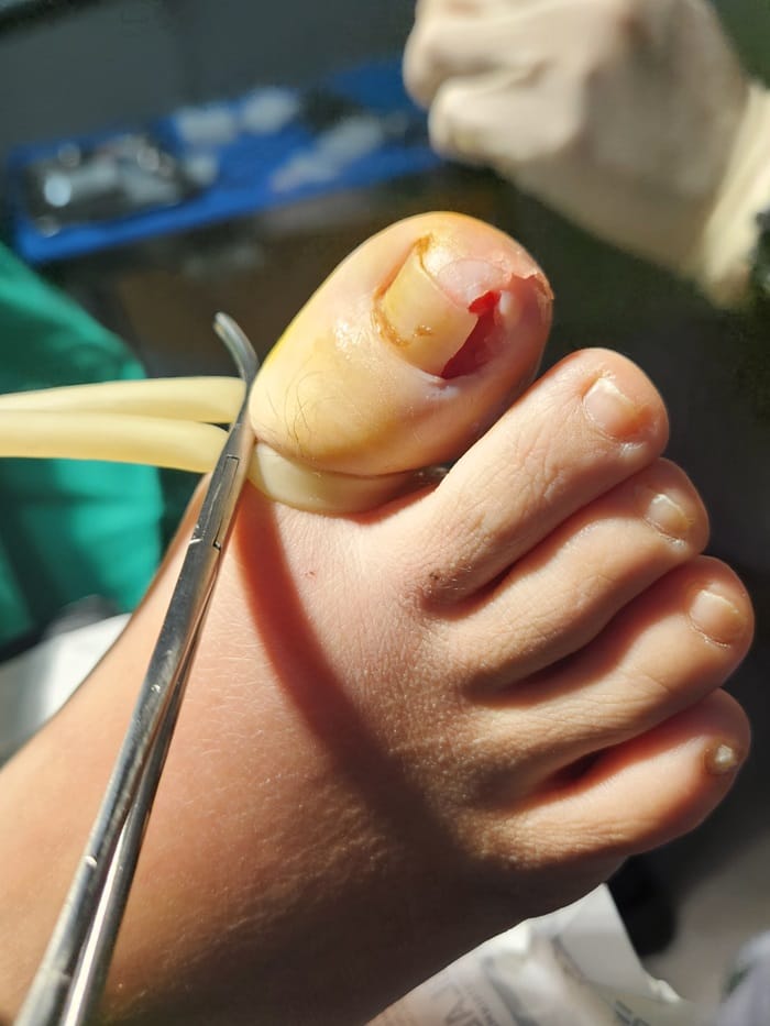Ingrown Toenail: Causes of Big Toe Pain and Nail Pus Explained — 5