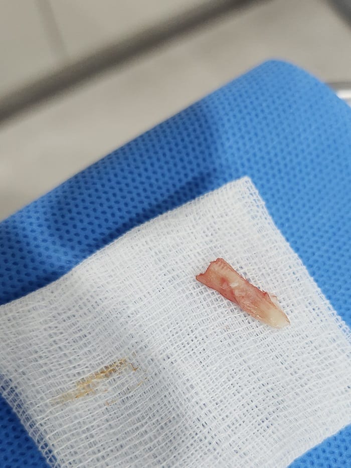 Ingrown Toenail: Causes of Big Toe Pain and Nail Pus Explained — 6