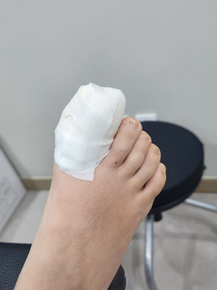 Ingrown Toenail: Causes of Big Toe Pain and Nail Pus Explained — 7