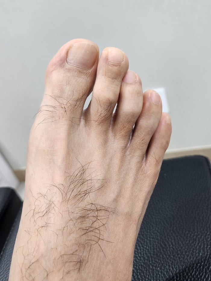 Corn and Callus Between the Fourth Toe: Why Identifying the Root Cause Matters