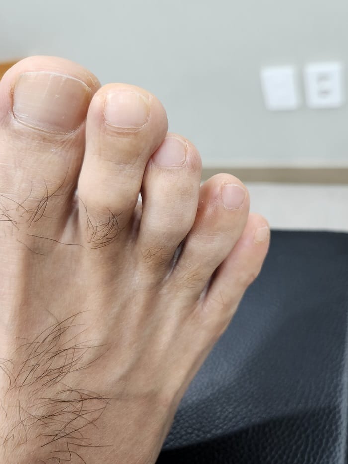 Corn and Callus Between the Fourth Toe: Why Identifying the Root Cause Matters — 2