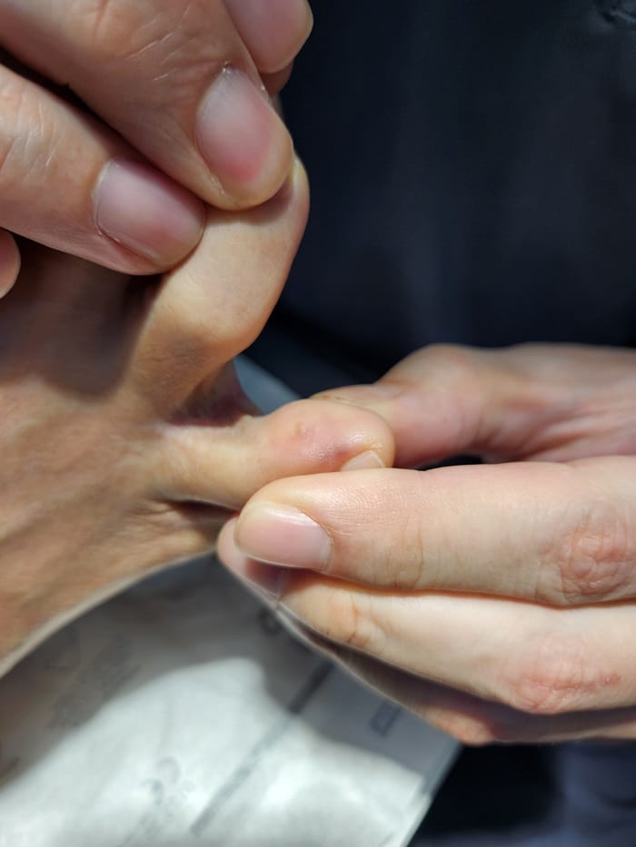 Corn and Callus Between the Fourth Toe: Why Identifying the Root Cause Matters — 3