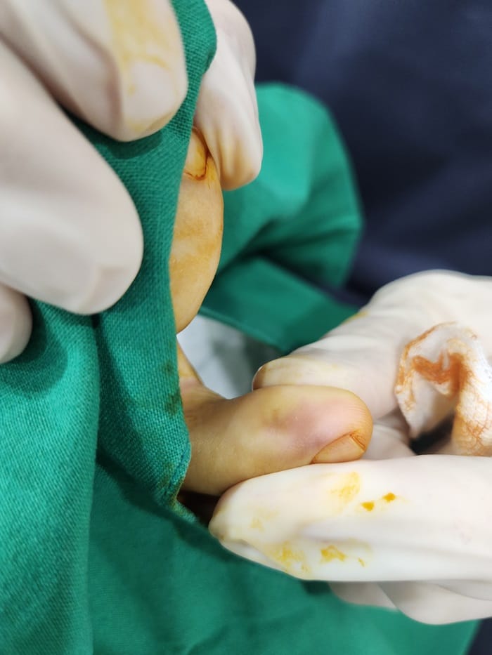 Corn and Callus Between the Fourth Toe: Why Identifying the Root Cause Matters — 4