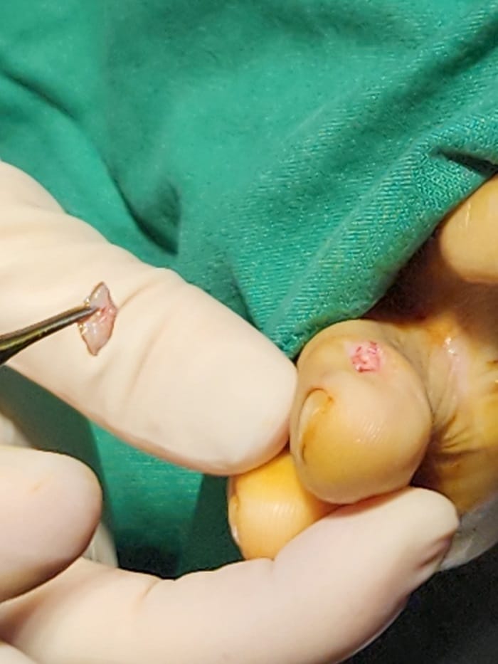 Corn and Callus Between the Fourth Toe: Why Identifying the Root Cause Matters — 5