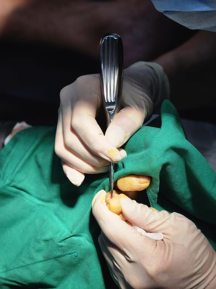 Corn and Callus Between the Fourth Toe: Why Identifying the Root Cause Matters — 6