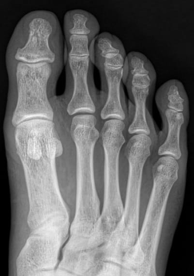 Corn and Callus Between the Fourth Toe: Why Identifying the Root Cause Matters — 7