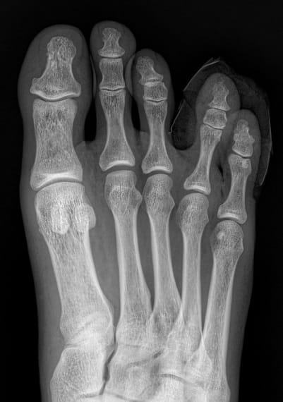 Corn and Callus Between the Fourth Toe: Why Identifying the Root Cause Matters — 8