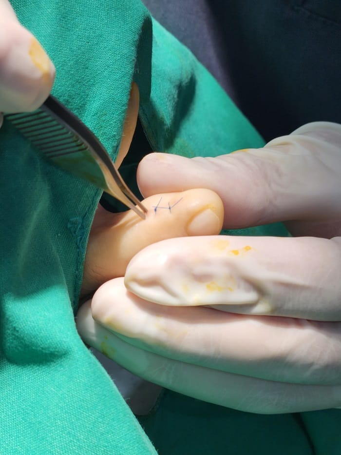 Corn and Callus Between the Fourth Toe: Why Identifying the Root Cause Matters — 9