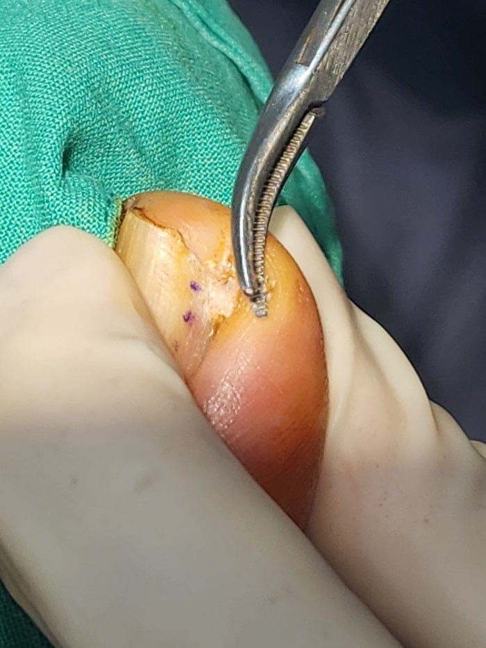 Big Toe Pain and Pus: Could an Ingrown Toenail Be the Cause? — 2