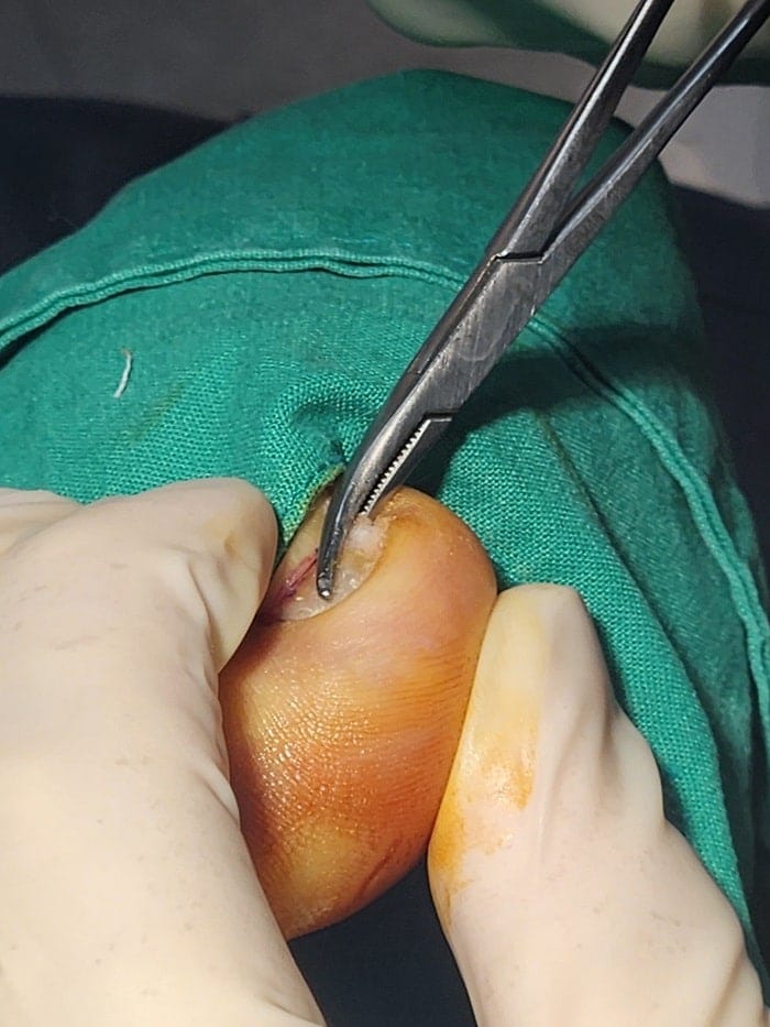 Big Toe Pain and Pus: Could an Ingrown Toenail Be the Cause? — 3
