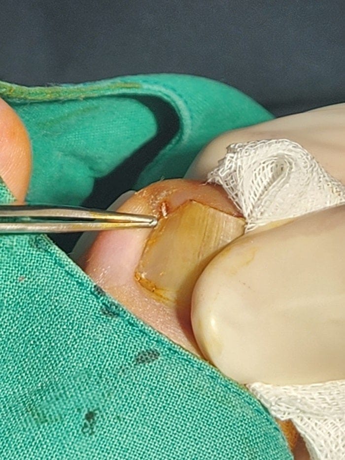 Big Toe Pain and Pus: Could an Ingrown Toenail Be the Cause? — 4