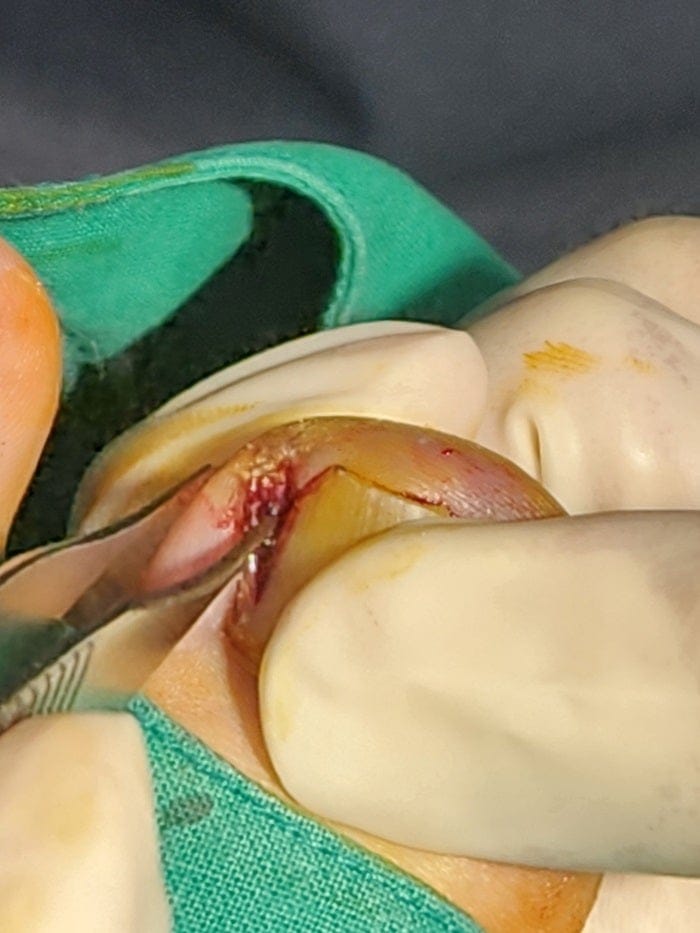 Big Toe Pain and Pus: Could an Ingrown Toenail Be the Cause? — 5