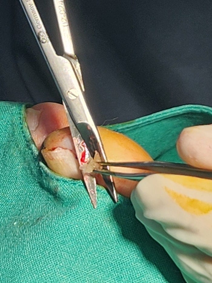 Big Toe Pain and Pus: Could an Ingrown Toenail Be the Cause? — 6
