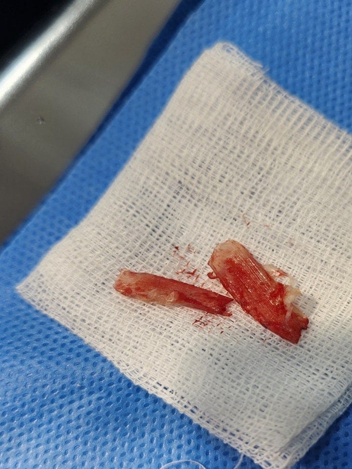 Big Toe Pain and Pus: Could an Ingrown Toenail Be the Cause? — 7