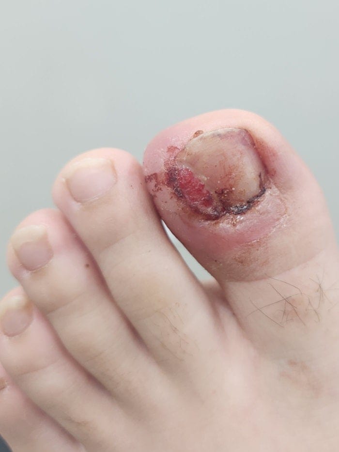 Ingrown Toenail Surgery: Removing the Root to Prevent Recurrence