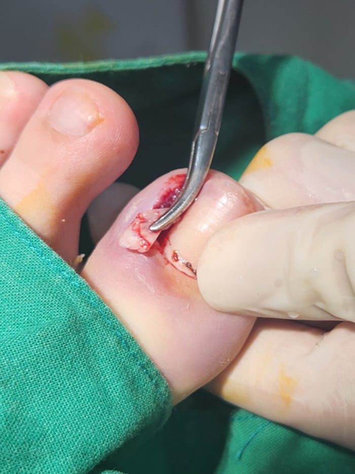Ingrown Toenail Surgery: Removing the Root to Prevent Recurrence — 5