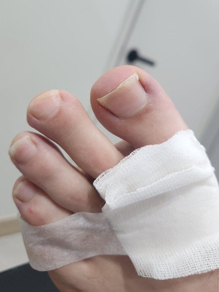 Ingrown Toenail Causing Big Toe Pain: Why Treating the Root Cause Is the Only Way to Prevent Recurrence