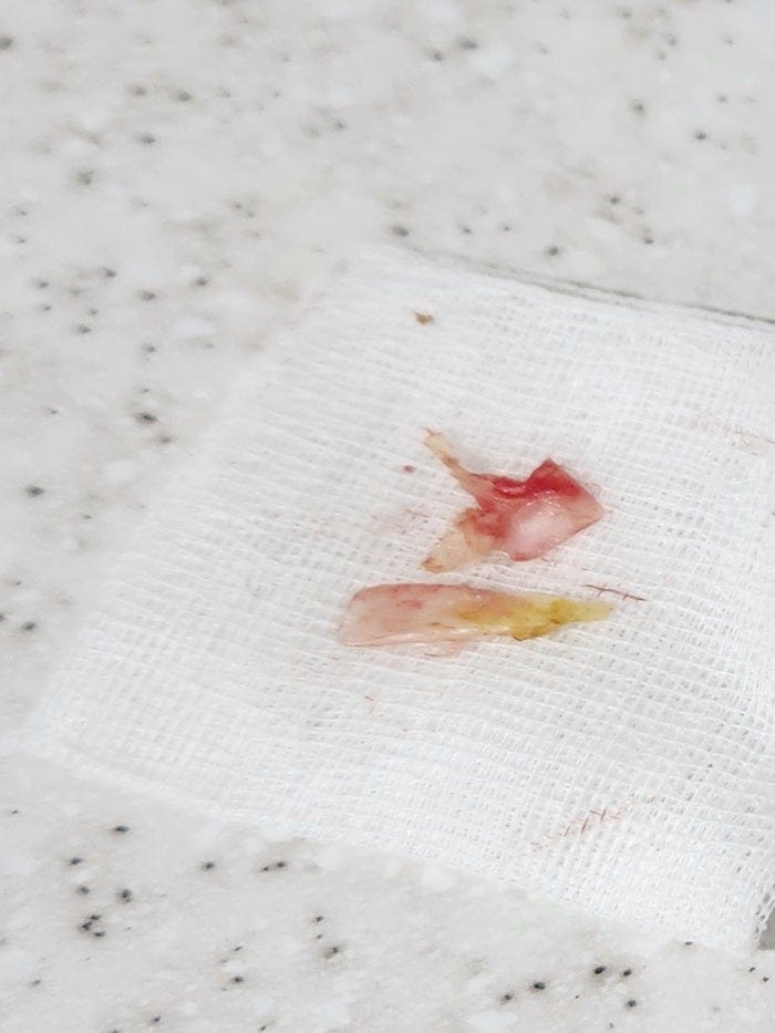 Ingrown Toenail Causing Big Toe Pain: Why Treating the Root Cause Is the Only Way to Prevent Recurrence — 4