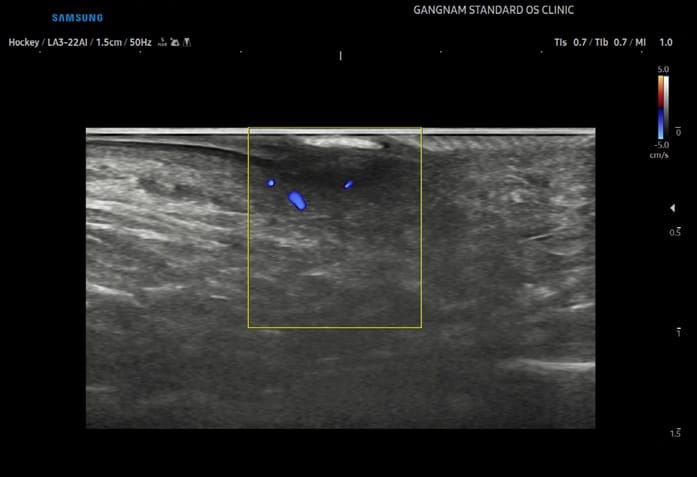 Plantar Wart Removal: Why You Need a Specialist Clinic to Prevent Recurrence — 2