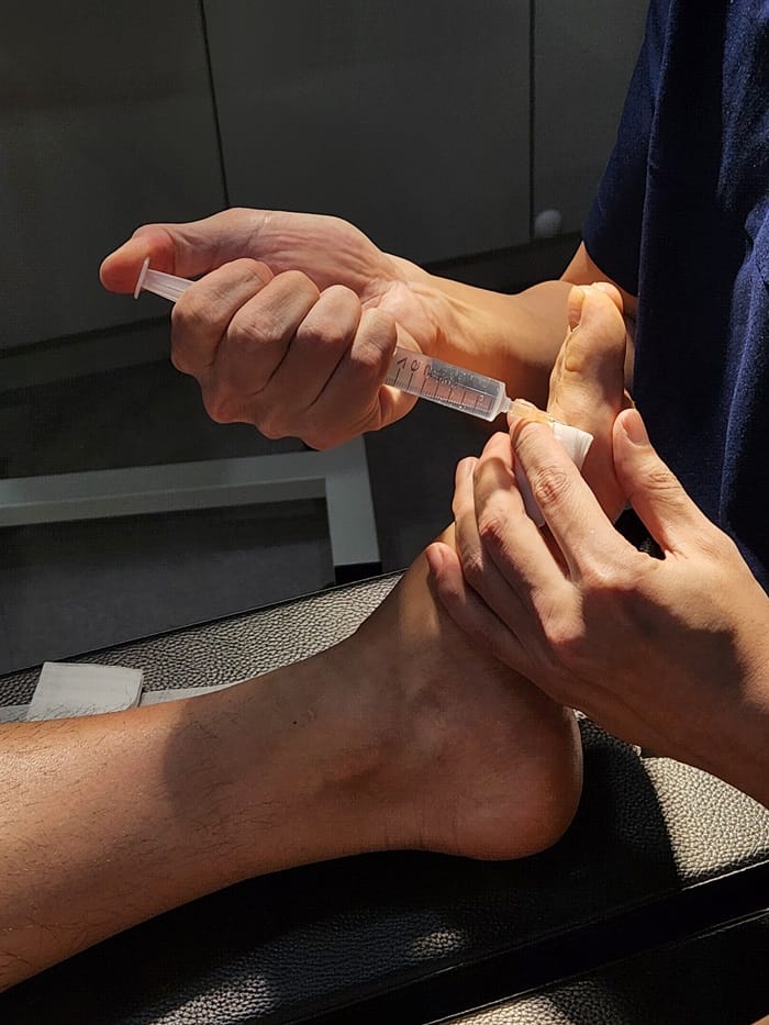 Plantar Wart Removal: Why You Need a Specialist Clinic to Prevent Recurrence — 3
