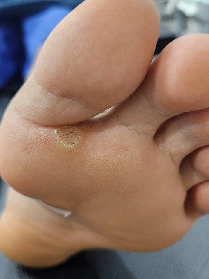 Plantar Wart Removal: Why You Need a Specialist Clinic to Prevent Recurrence — 4