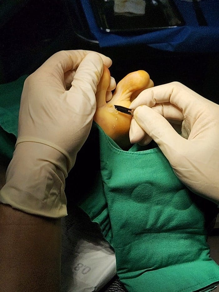 Plantar Wart Removal: Why You Need a Specialist Clinic to Prevent Recurrence — 6